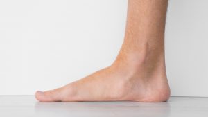 Platfod og overpronation