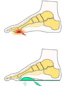 Metatarsalgia Forfodsindl g S ler Med Forfodspelotte